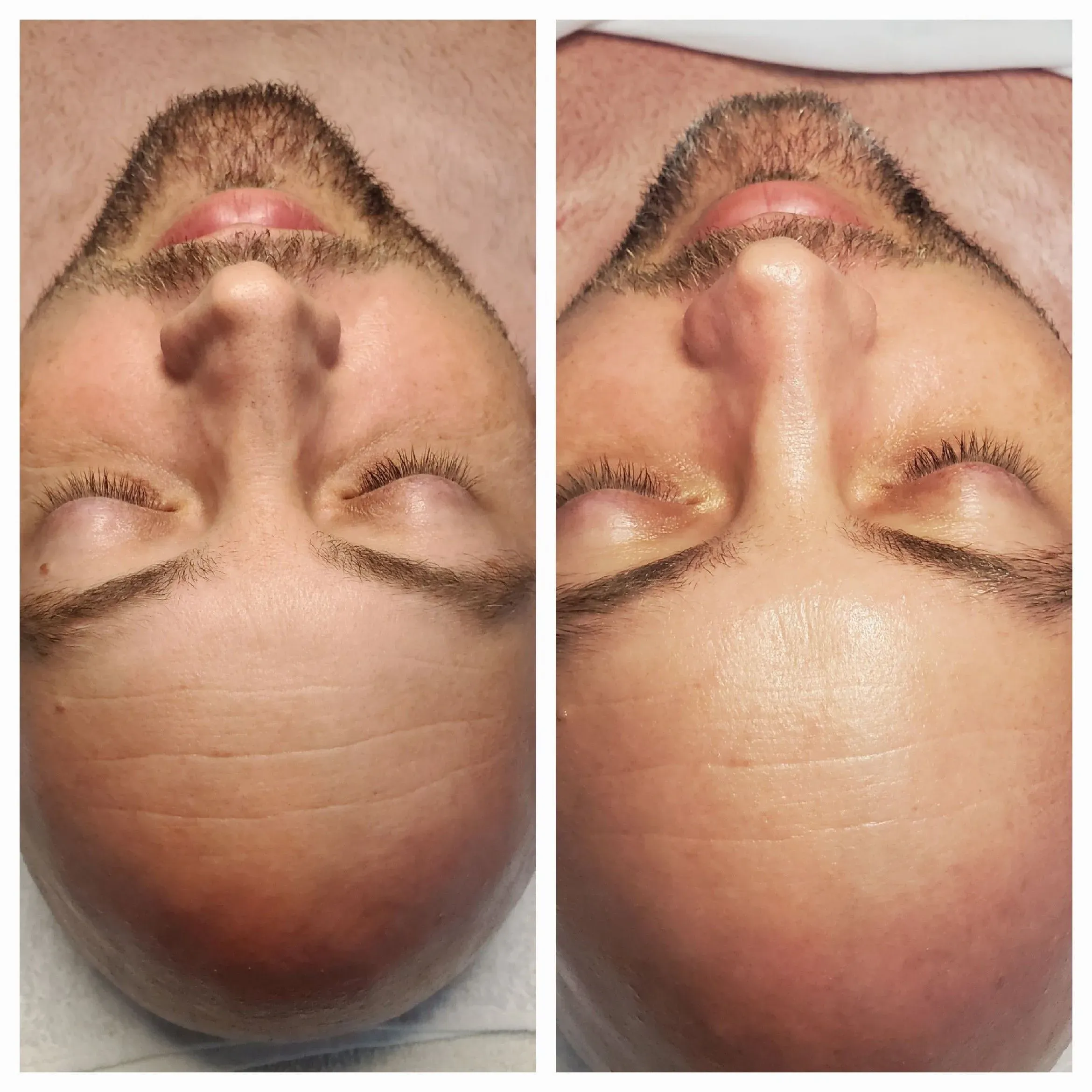 Before and after facial results at Elevé Esthetics