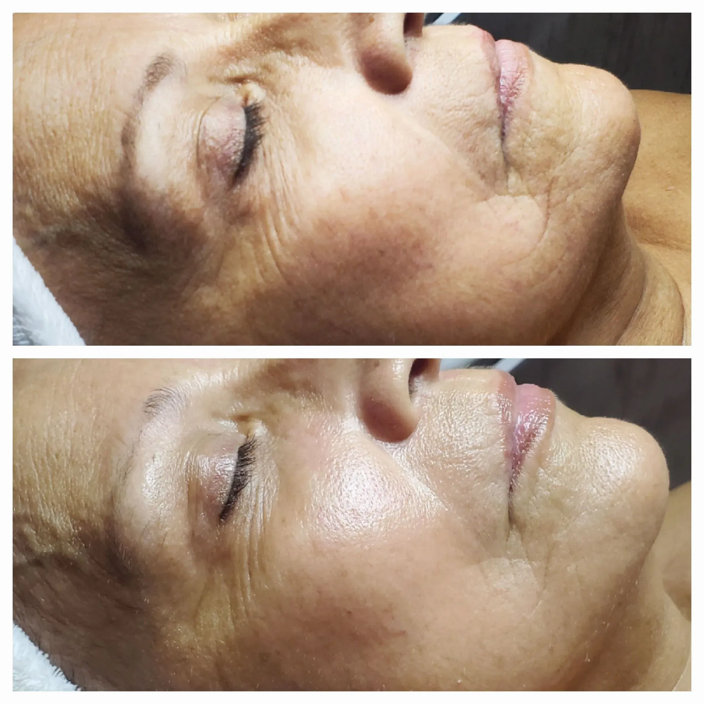 Before and after facial results at Elevé Esthetics
