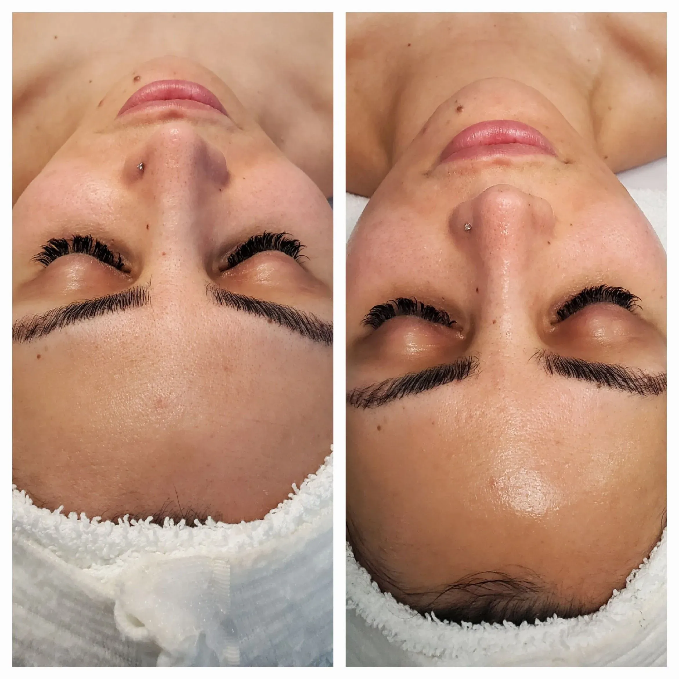 Before and after facial results at Elevé Esthetics