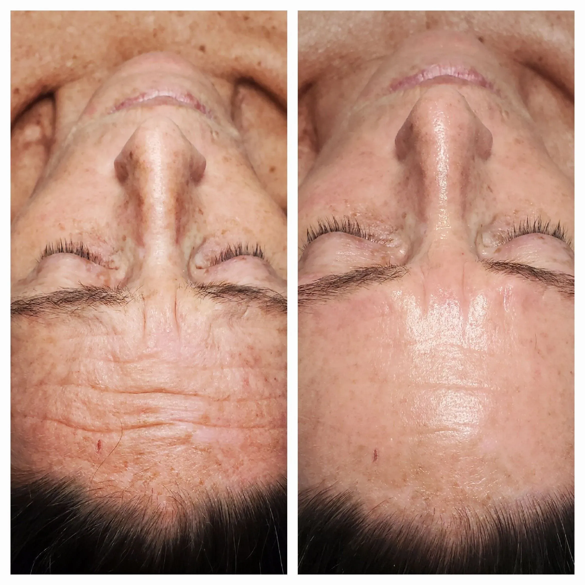 Before and after facial results at Elevé Esthetics