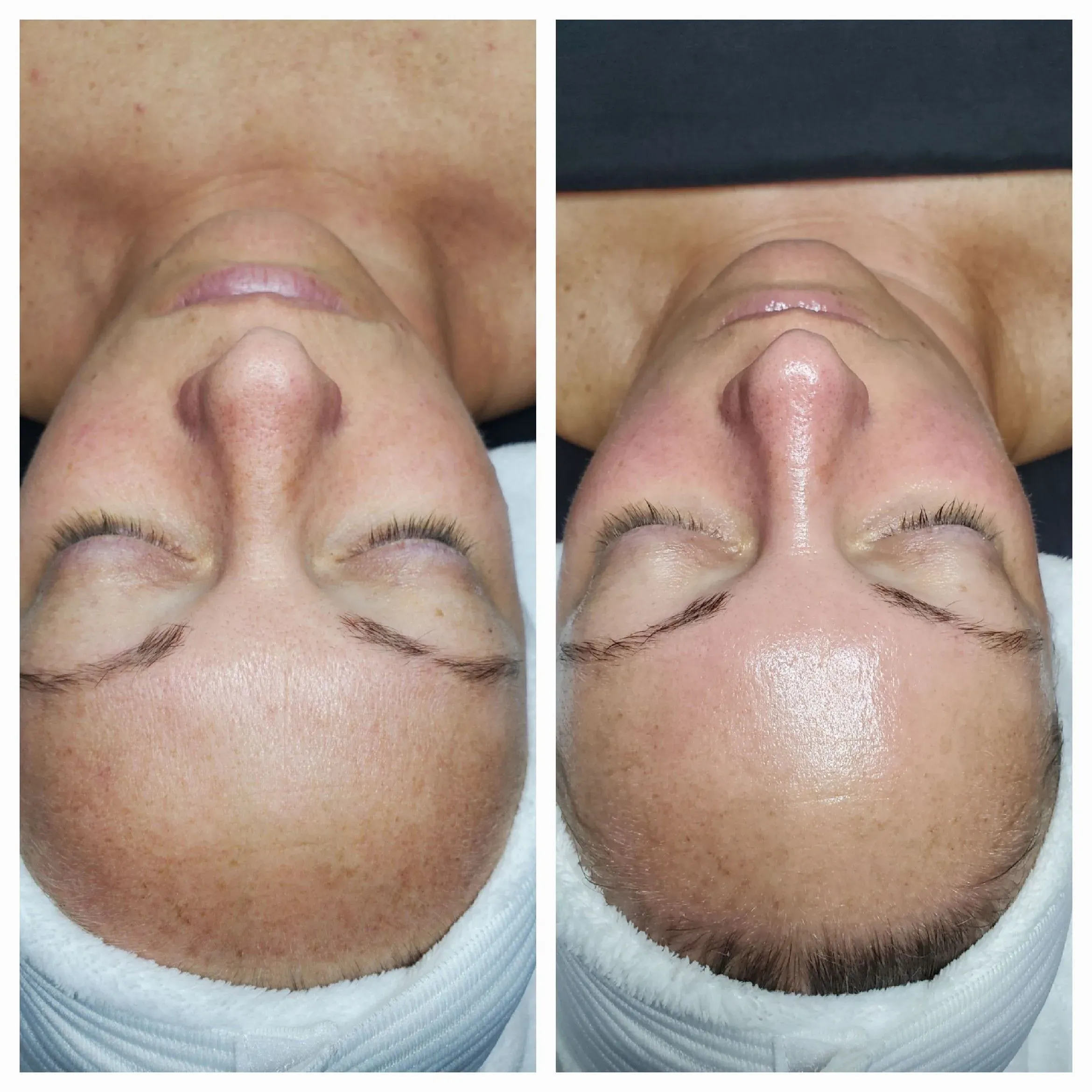 Before and after facial results at Elevé Esthetics