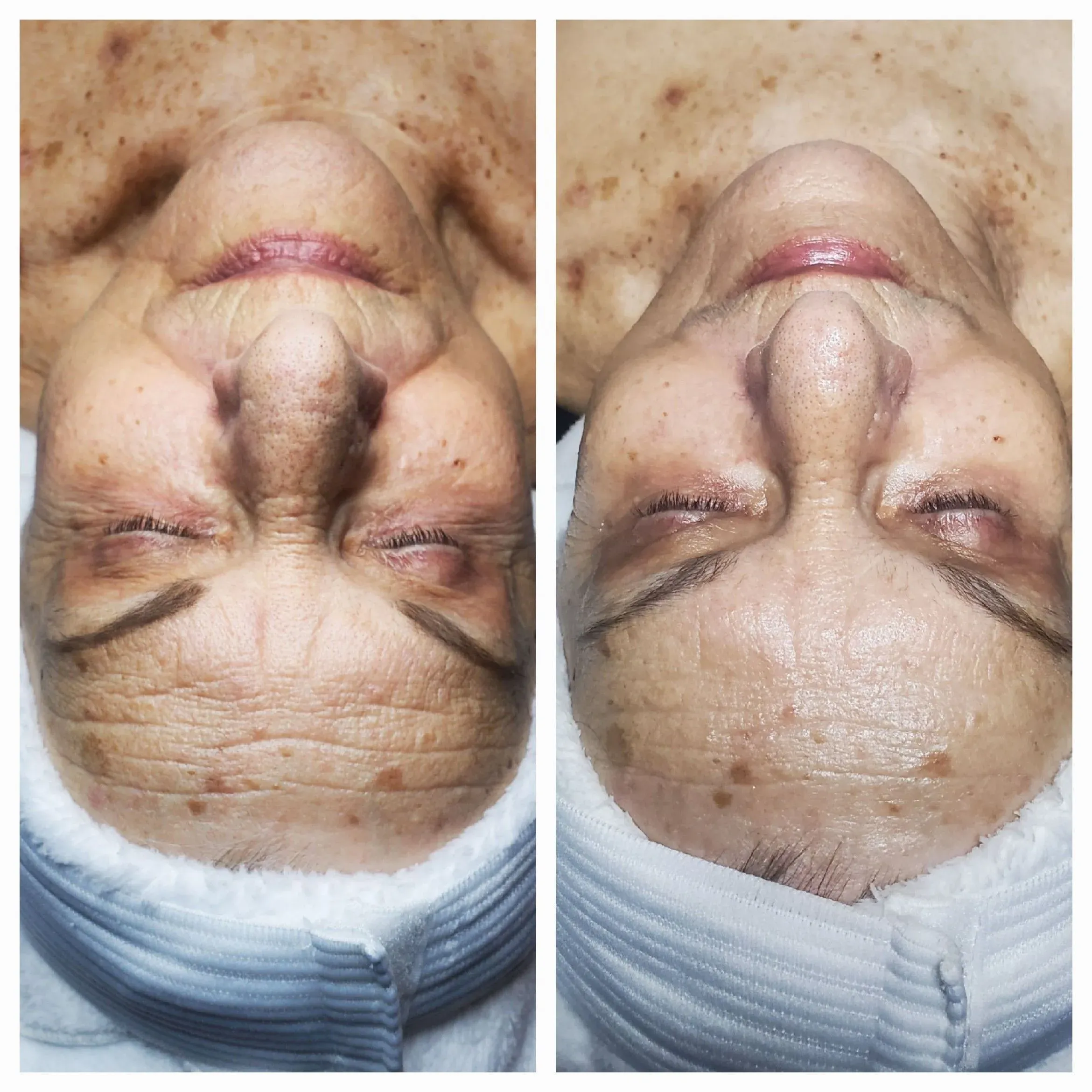 Before and after facial results at Elevé Esthetics
